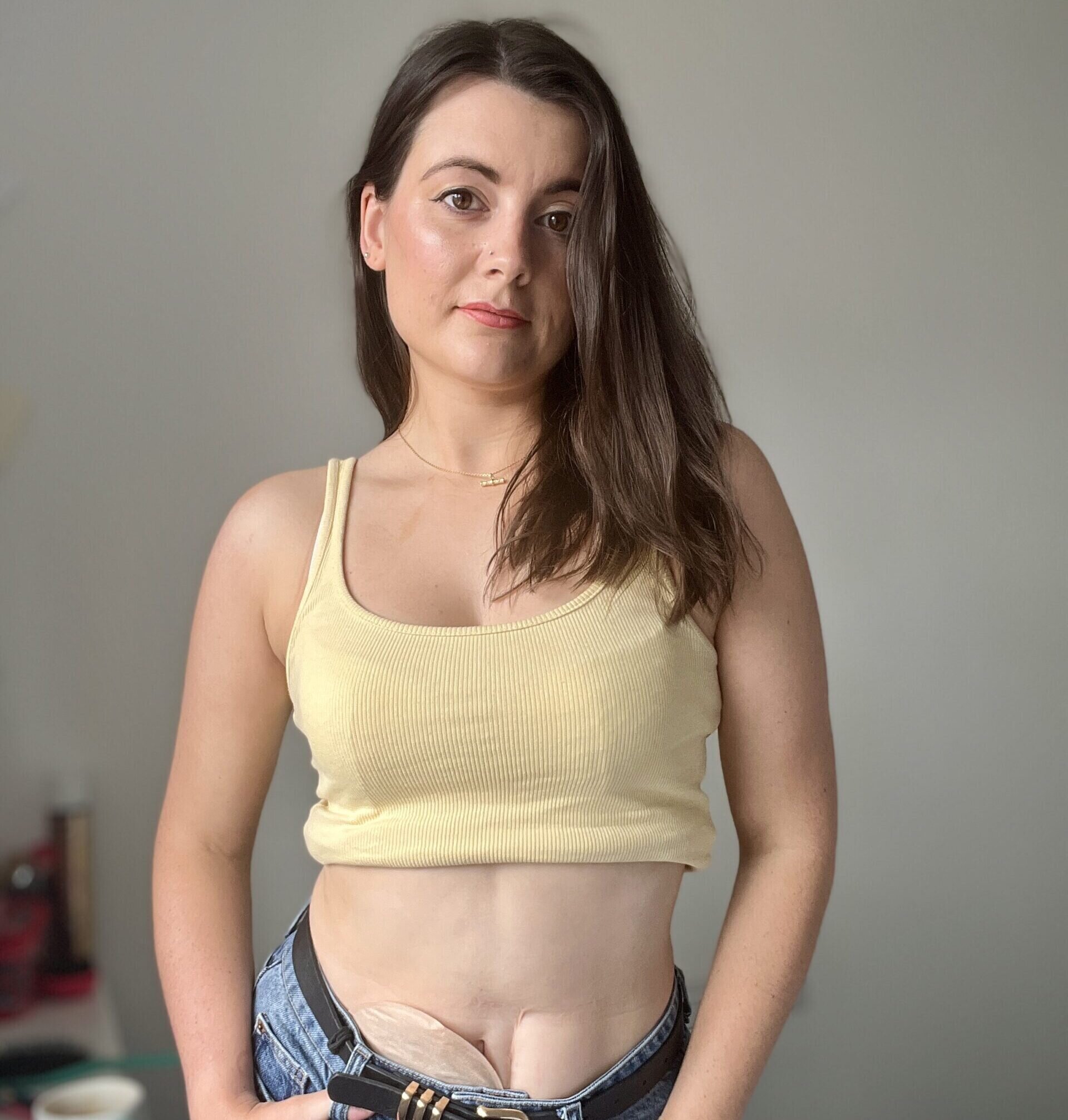 Amy poses in front of the camera wearing a yellow top, blue jeans and has her stoma bag on show.